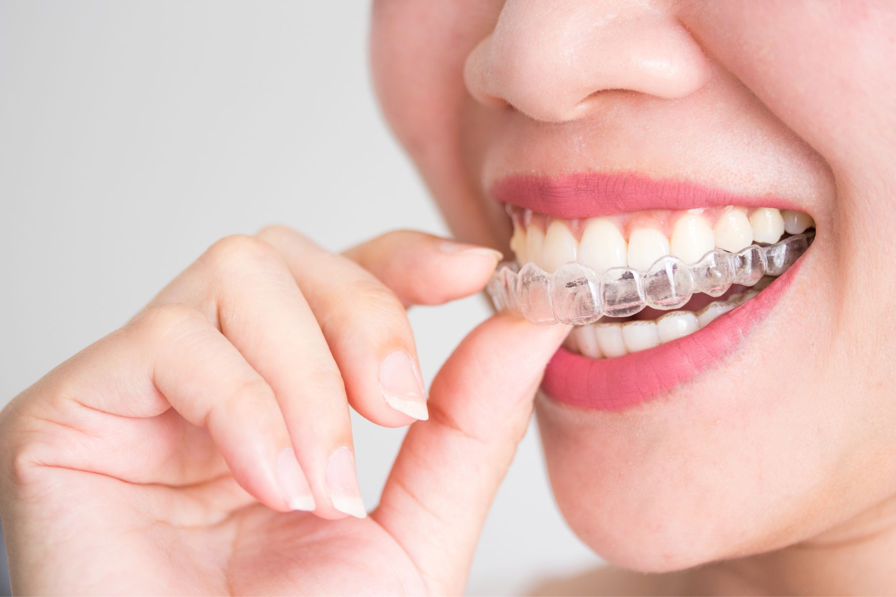 5 zalet nakładek ortodontycznych na zęby