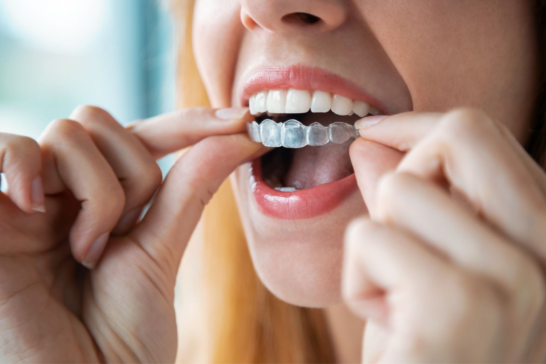 Jak prawidłowo korzystać z nakładek ortodontycznych?