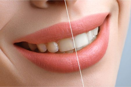 Jak wygląda wybielanie zębów w domu?