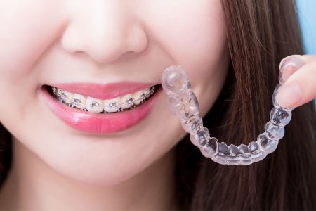 Prostujące nakładki na zęby a aparat ortodontyczny