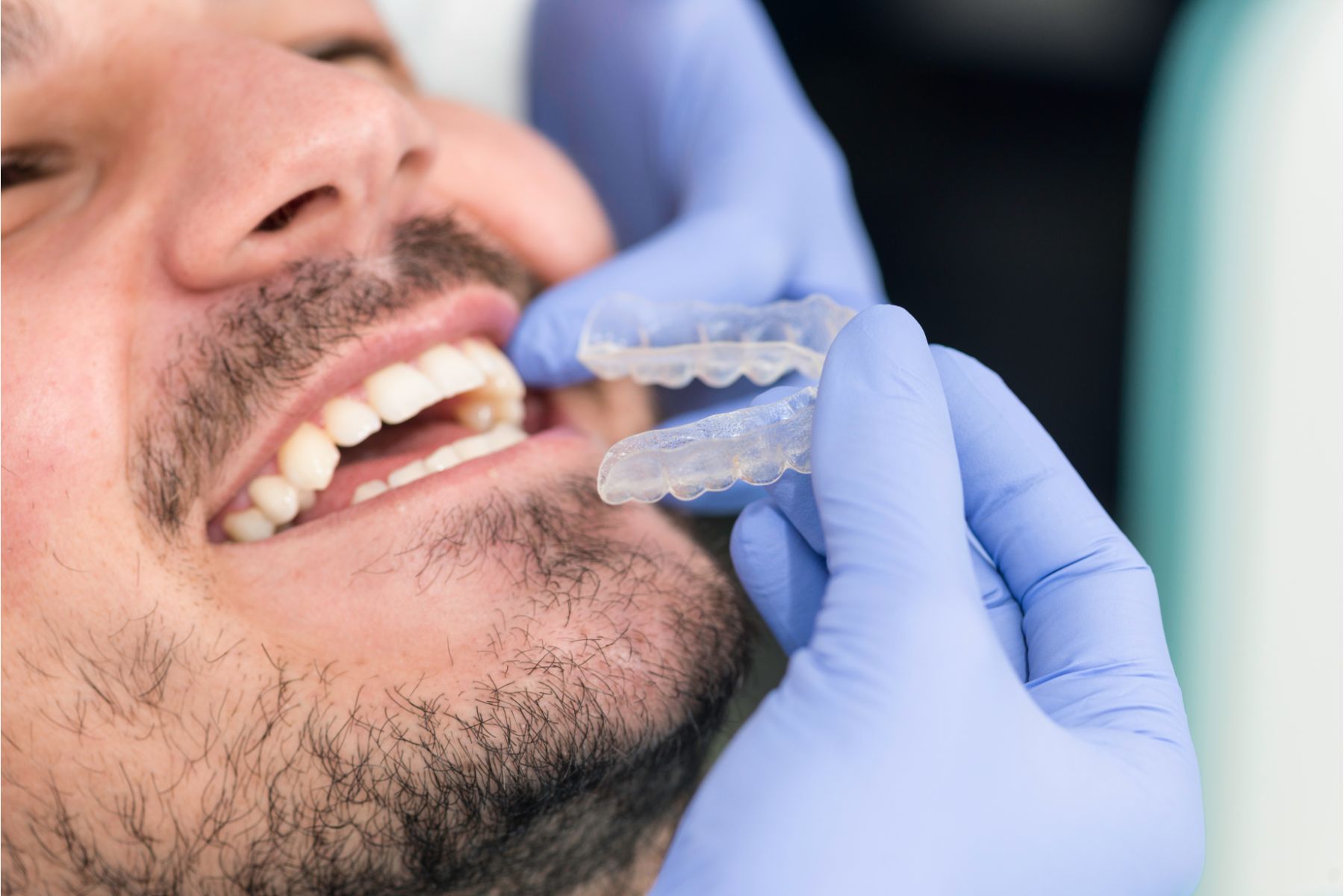 Ile kosztuje leczenie nakładkowym aparatem ortodontycznym?